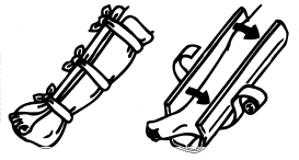 T骨折1.gif