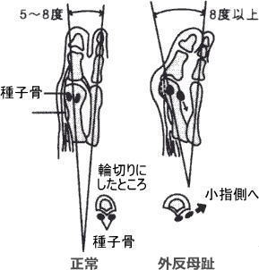 外反母趾1