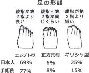 外反母趾2