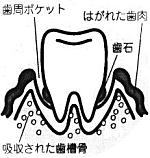 歯周病の進行状態